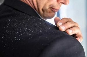 dandruff-causes-in-winter-and-home-remedies-to-avoid-dandruff-1_optimized