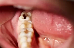 How-to-remove cavity-from teeth-at-home-tooth-decay-treatment-danto-se-kide-nikalne-gharelu-tarike-2