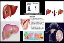 fatty liver can also cause liver cancer  tips-tricks to avoid cancer,भारत में हर 10 इंसान में से 1 व्यक्ति को है यह रोग, हो सकता है कैंसर ...fatty liver diet, fatty liver diet chart indian, fatty liver disease, fatty liver grade 1, fatty liver grade 1 means, fatty liver ke lakshan, fatty liver symptoms, fatty liver treatment, liver cancer causes, liver cancer ke lakshan, liver cancer stages, liver cancer symptoms, liver cancer symptoms in hindi, liver cancer test, liver cancer treatment, liver cancer treatment cost, फैटी लिवर के लक्षण, फैटी लीवर, लीवर कमजोर के लक्षण, लीवर की आयुर्वेदिक दवा, लीवर की दवा, लीवर के लिए अंडा, लीवर के लिए जूस, लीवर के लिए फायदेमंद फल, लीवर कैंसर के लक्षण, लीवर बढ़ने के लक्षण, लीवर मीनिंग इन हिंदी, लीवर सिरोसिस के लक्षण
