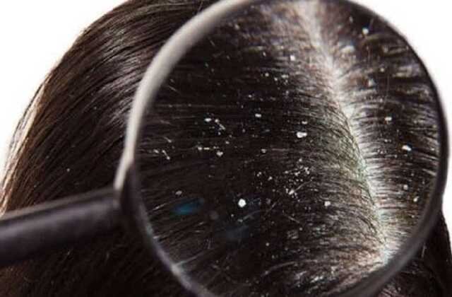 home-remedies-to-avoid-dandruff_optimized