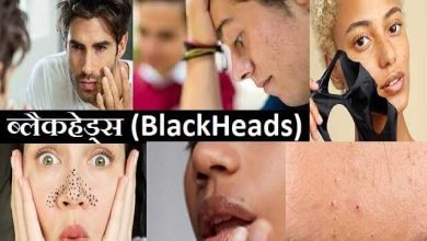 How to remove blackheads home remedies for skin, Green Tea आपकी त्वचा के लिए है वरदान, लगाओ इसे बनो जवान, remedies for blackheads, ब्लैकहेड्स