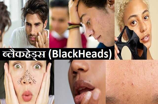 How to remove blackheads home remedies for skin, Green Tea आपकी त्वचा के लिए है वरदान, लगाओ इसे बनो जवान, remedies for blackheads, ब्लैकहेड्स