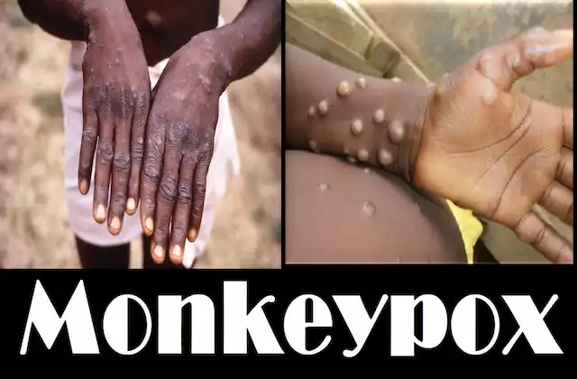 Monkeypox-alert-sends-by-Indian-govt-to-all-international-entry-points-NCDC-ICMR