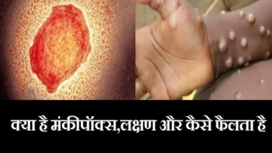 Monkeypox-kya-hai-what-are-symptoms-of-monkeypox-how-spread-causes-treatment
